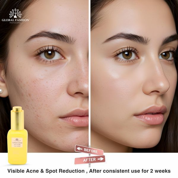Сыворотка с куркумой от акне, Global Fashion, Turmeric Serum Anti-Acne, 50 мл 25081 фото